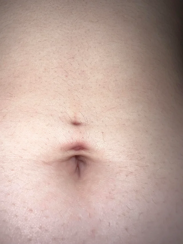 A picture of an infected belly