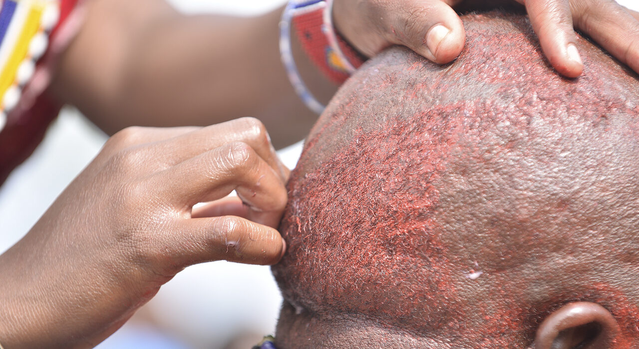 A Cancer patient shaving head.