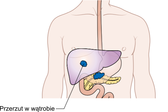 A picture showing Diagram showing pancreatic-cancer