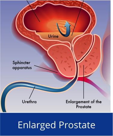 An image of enlarge prostrate