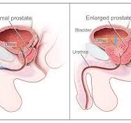 Reduce prostate without surgery