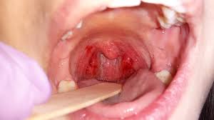 A picture of mouth-with throat cancer